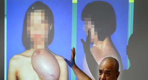 福建毀容少女將換臉